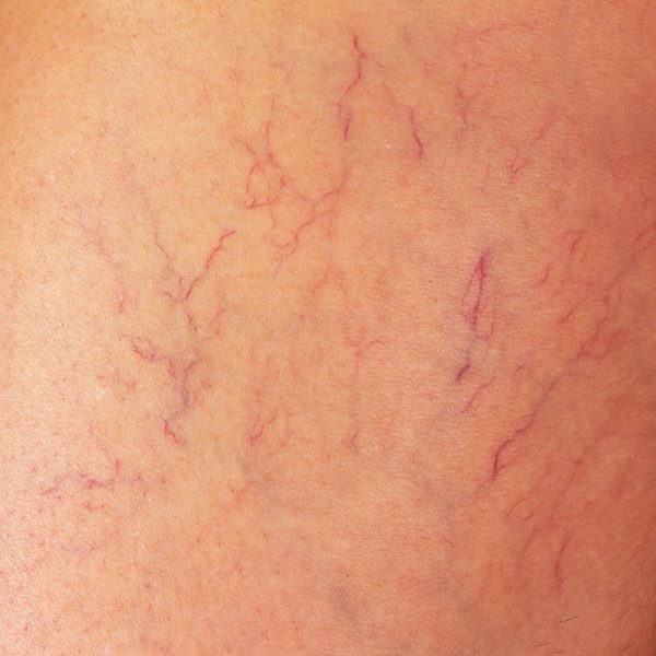varicose veins on the thigh of a woman close up
