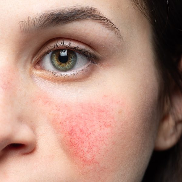 A case of early rosacea on a young woman's face.