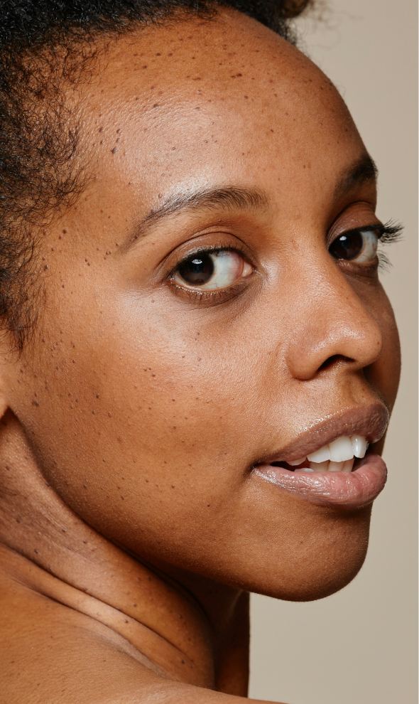 Close up of a woman's face with dark spots across her cheek and forehead