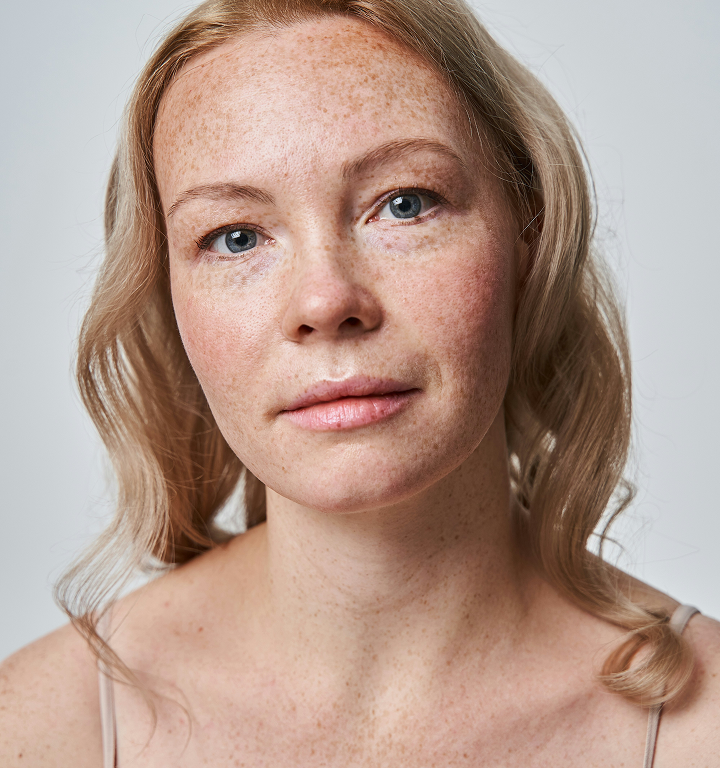 A woman with fair, freckled skin and light redness across her cheeks