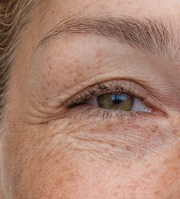 fine-lines-and-wrinkles